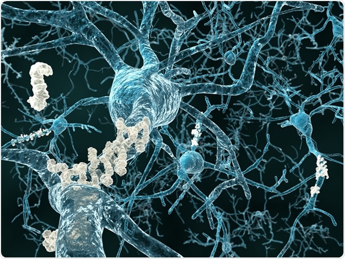 Alzheimer's disease - neurons with amyloid plaques. Image Credit: Juan Gaertner / Shutterstock